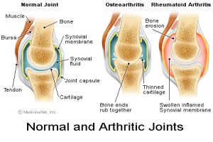 An example of arthritic joints. Courtesy of medicinenet.com